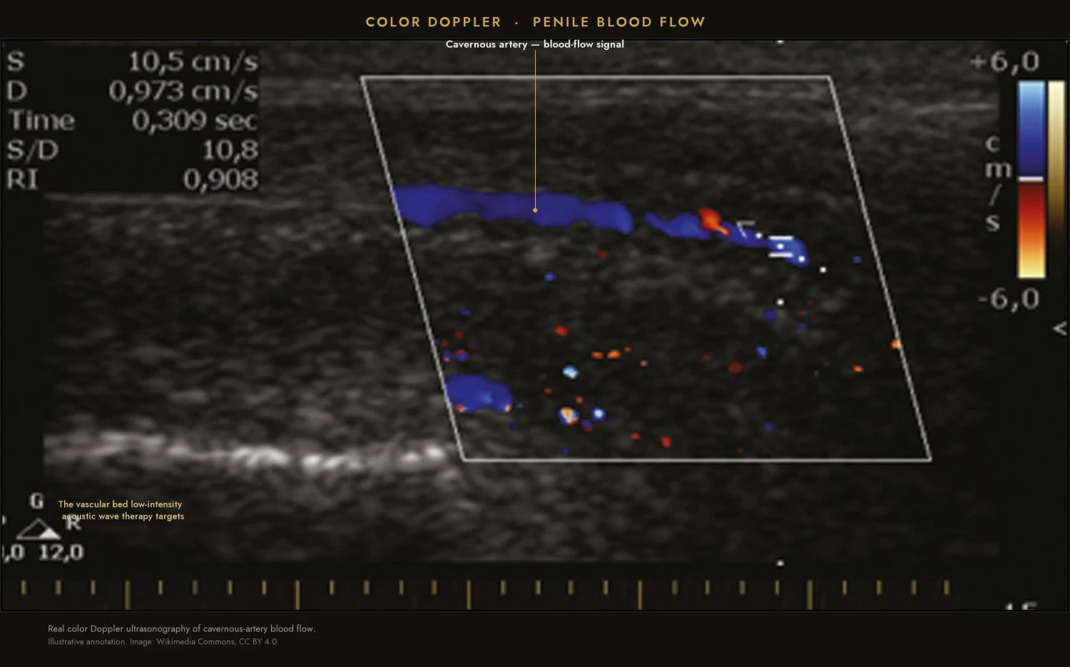 Editorial illustration of acoustic waves reaching aging vascular tissue